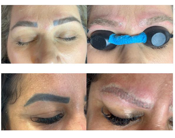 Antes e depois da remoção de micropigmentação de sobrancelhas a laser